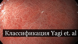 Классификация ямочного и капиллярного рисунка Yagi A–B желудка: B-0–B-3, A-0–A-2, RAC